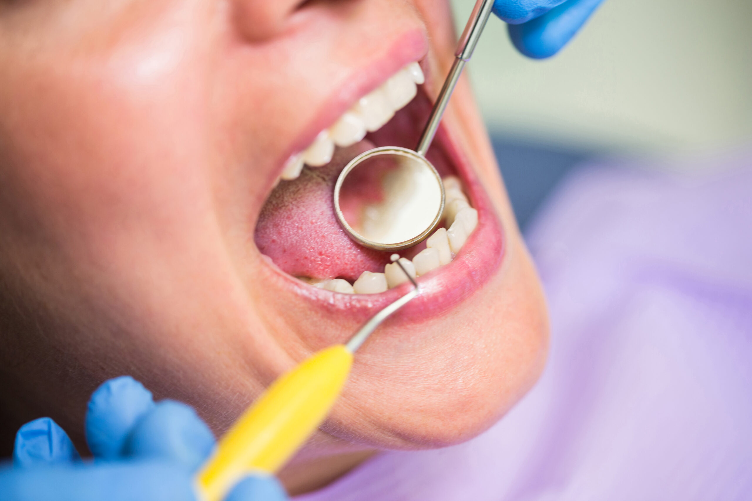 dental fillings in Beverly Hills
