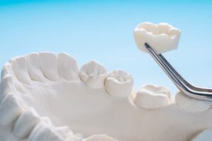 dental crowns in Beverly Hills