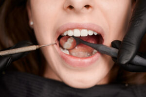 tooth extraction in Beverly Hills