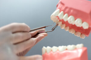 tooth bridges