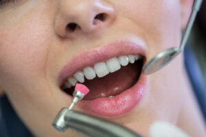 veneers