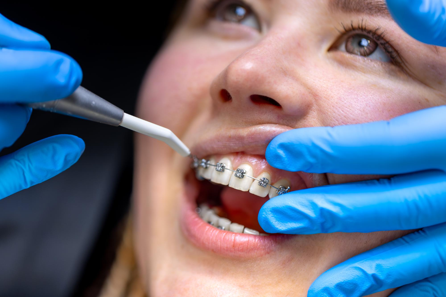 teeth braces near me